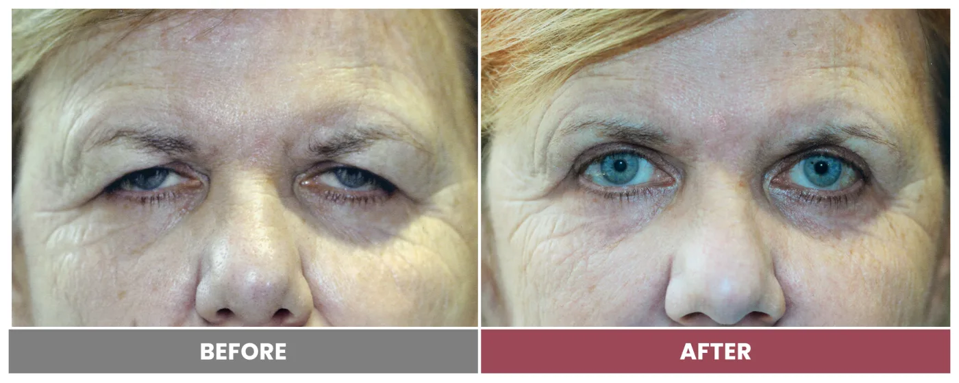 Upper Blepharoplasty - Case 81
