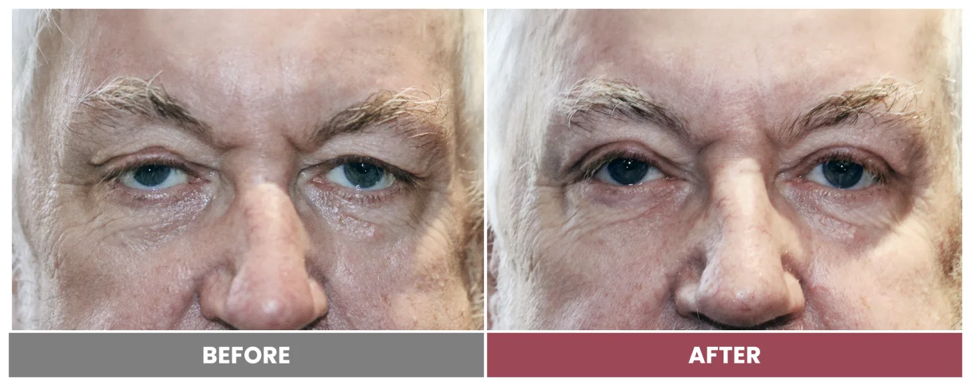 Upper Blepharoplasty - Case 83