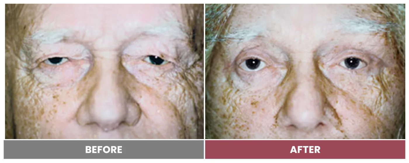 Upper Blepharoplasty - Case 86