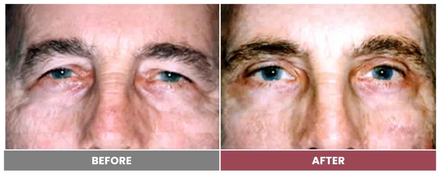 Upper Blepharoplasty - Case 92