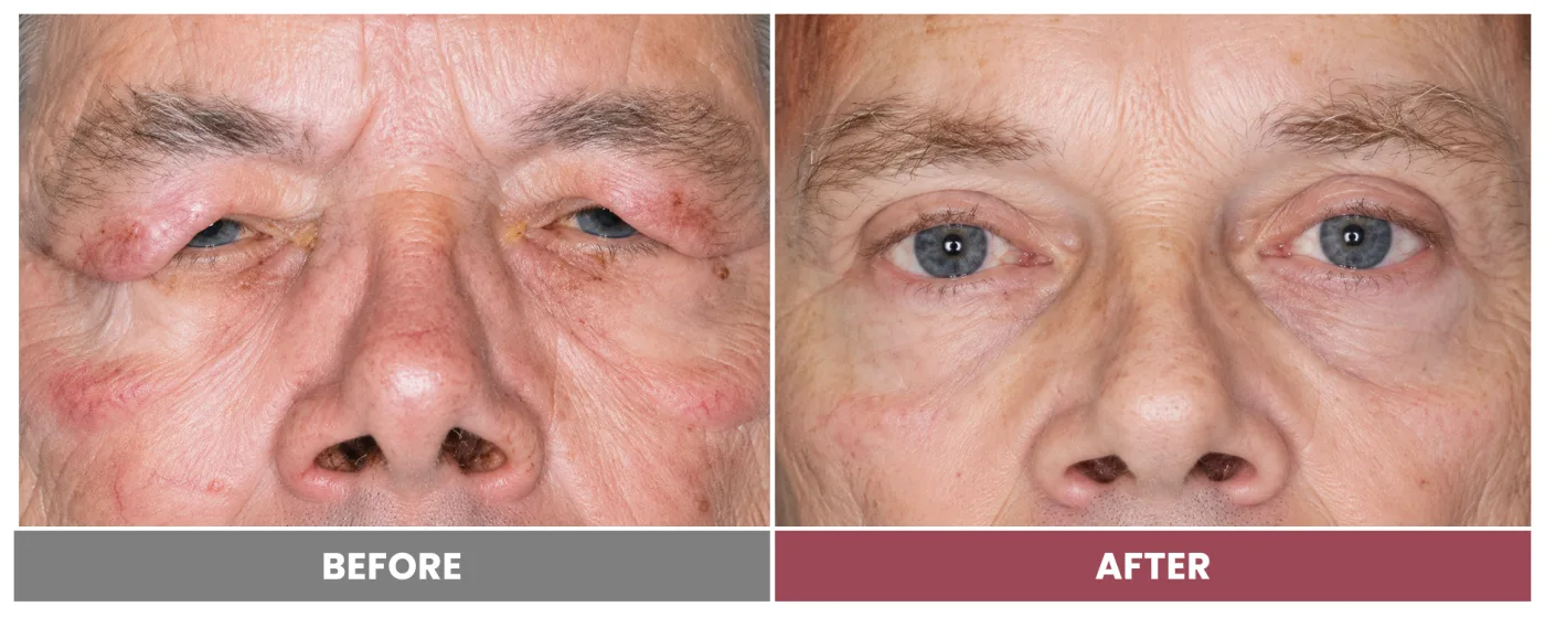 Upper Blepharoplasty - Case 94