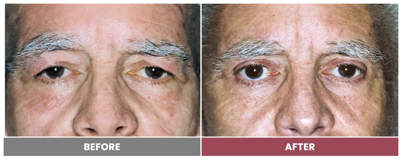 Upper Blepharoplasty - Case 95