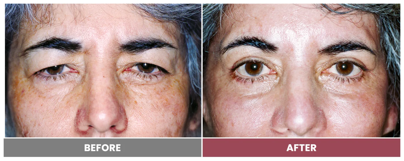 Upper Blepharoplasty - Case 96