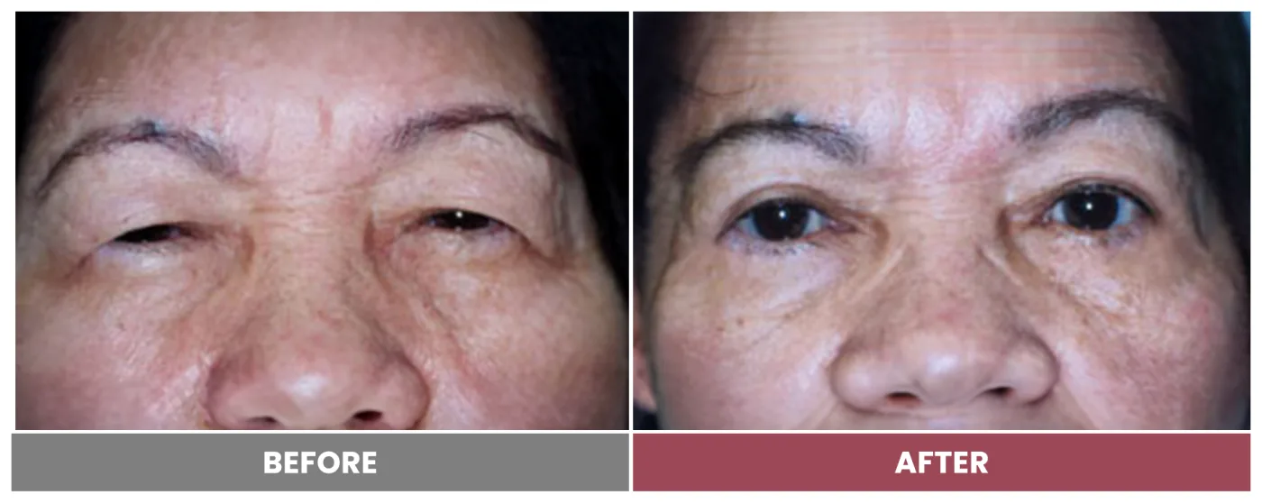 Upper Blepharoplasty - Case 97