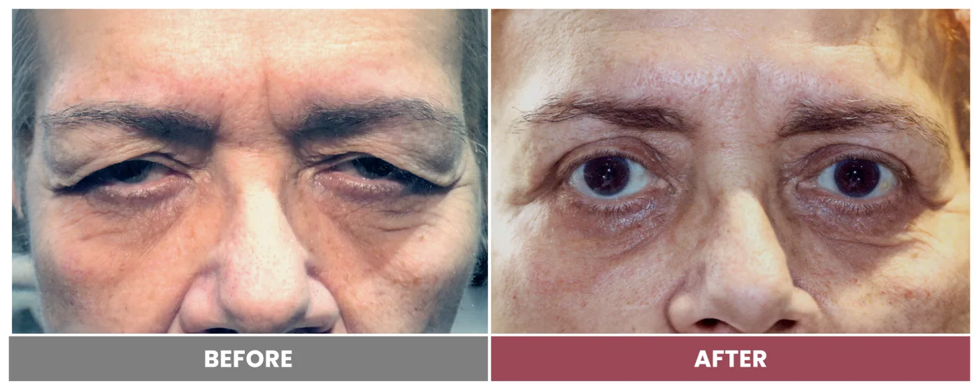 Upper Blepharoplasty - Case 99