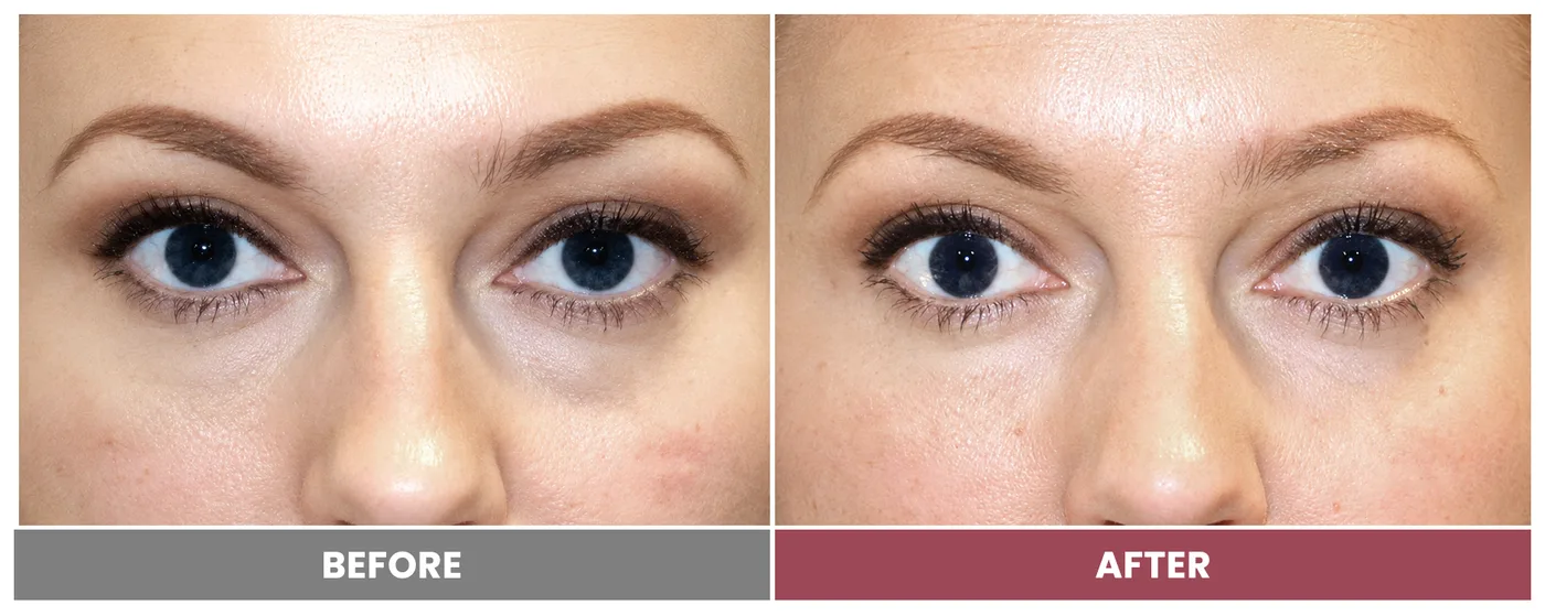 5D FACE LIFT - Case 1