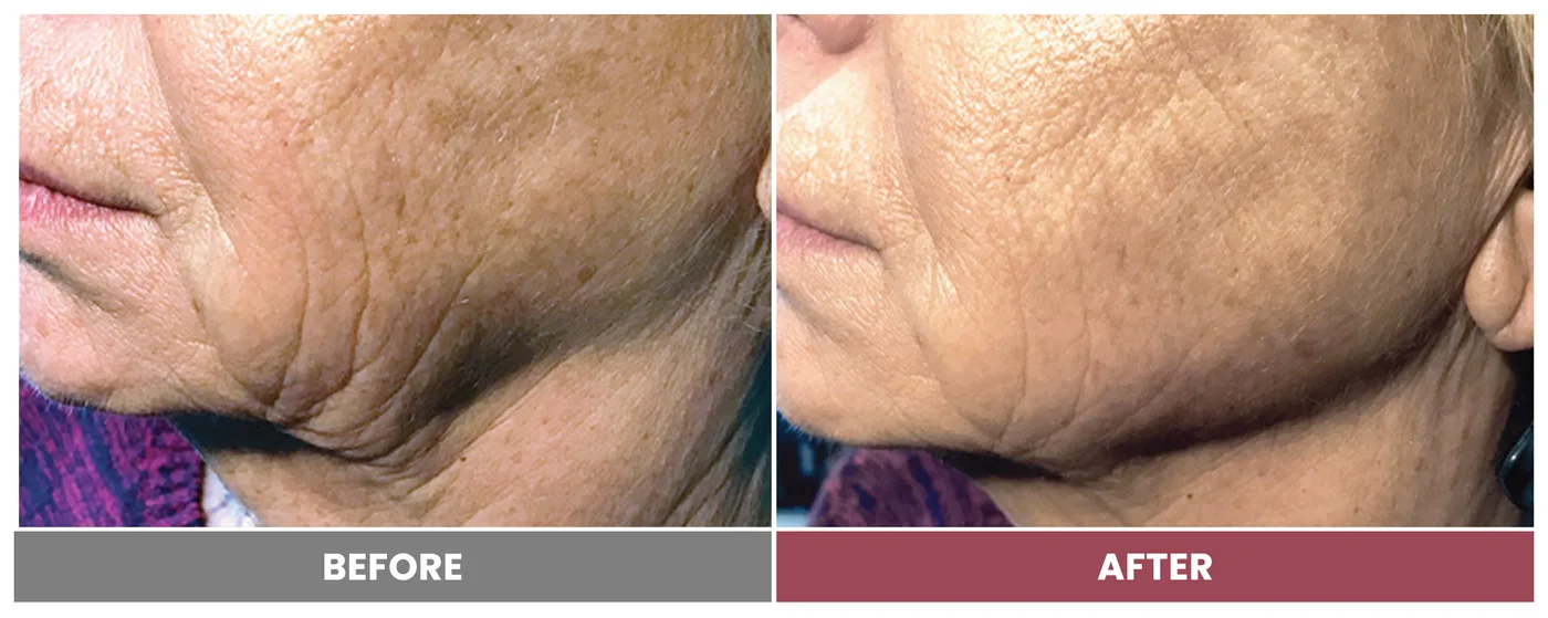 5D FACE LIFT - Case 2