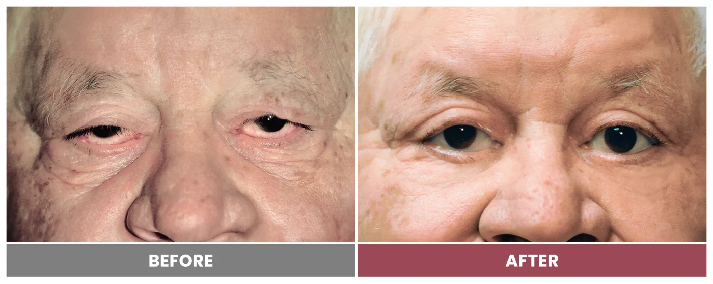 BLEPHAROPLASTY & PTOSIS REPAIR - Case 3