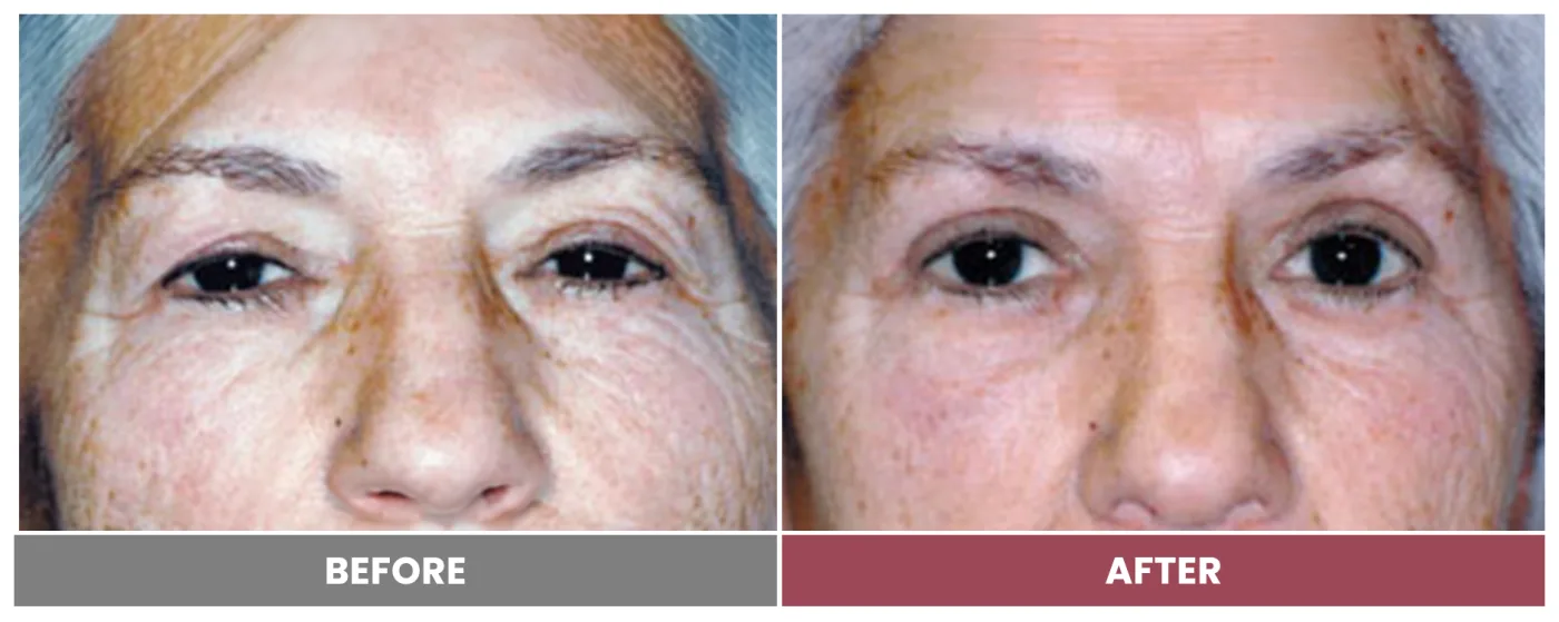 BLEPHAROPLASTY & PTOSIS REPAIR - Case 4