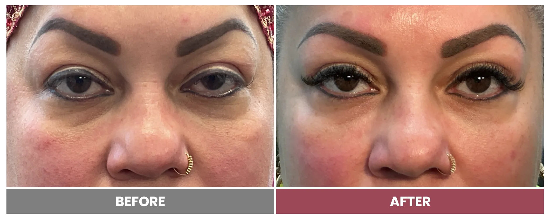BLEPHAROPLASTY & PTOSIS REPAIR - Case 9