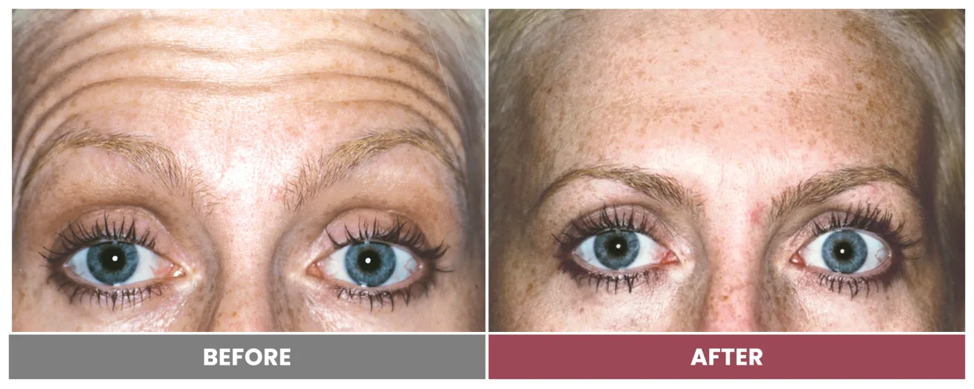 NEUROMODULATORS & DERMAL FILLERS - Case 1