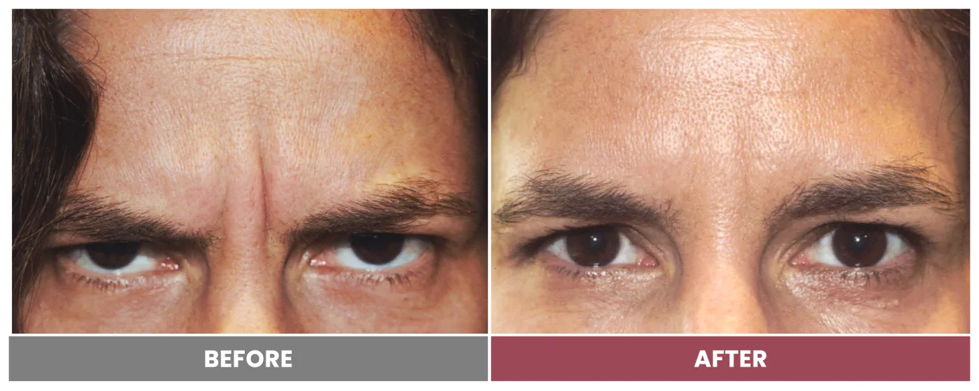 NEUROMODULATORS & DERMAL FILLERS - Case 11