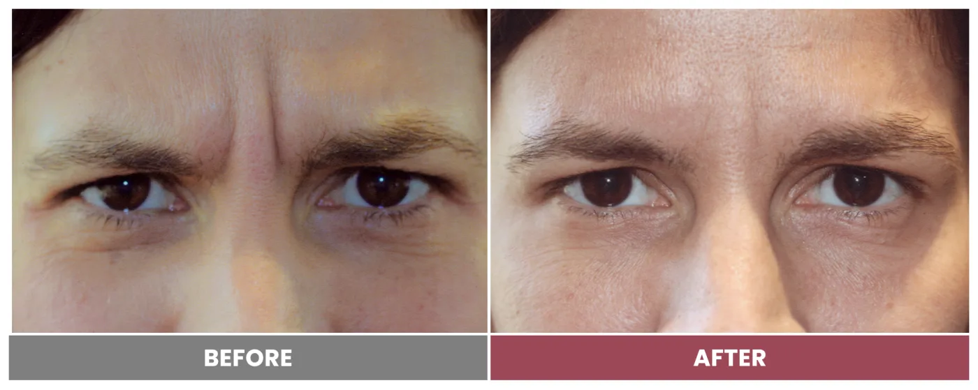 NEUROMODULATORS & DERMAL FILLERS - Case 13