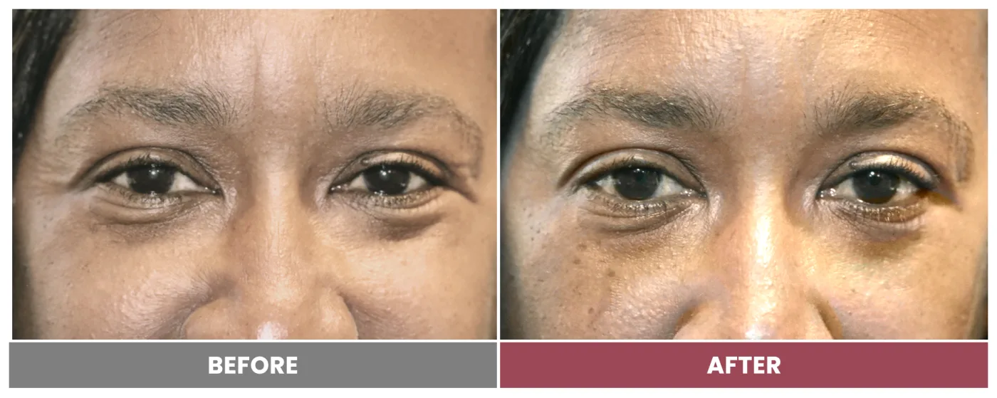 NEUROMODULATORS & DERMAL FILLERS - Case 14