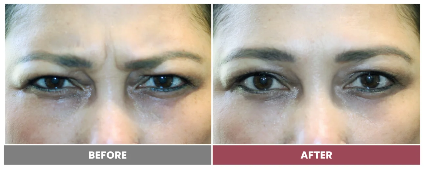 NEUROMODULATORS & DERMAL FILLERS - Case 15