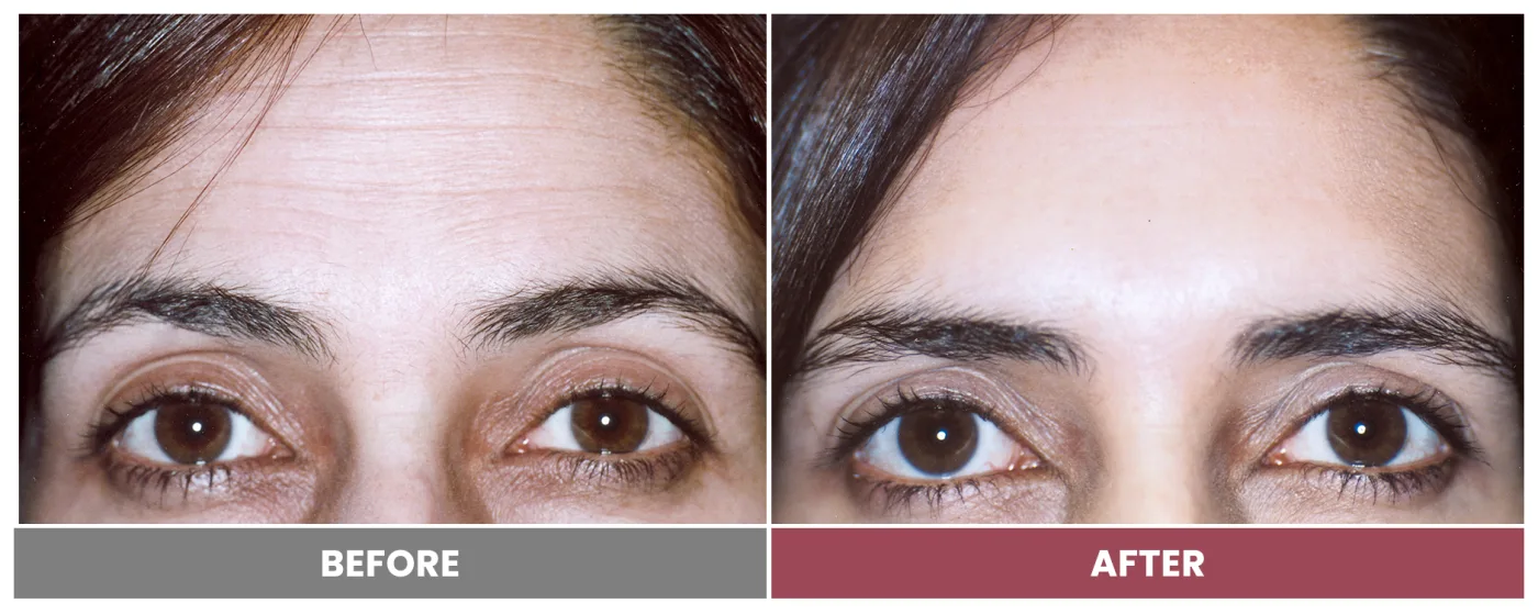 NEUROMODULATORS & DERMAL FILLERS - Case 17