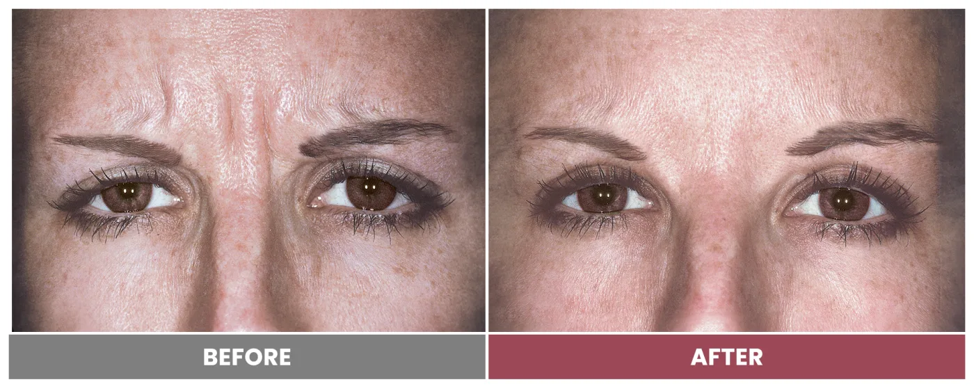 NEUROMODULATORS & DERMAL FILLERS - Case 18