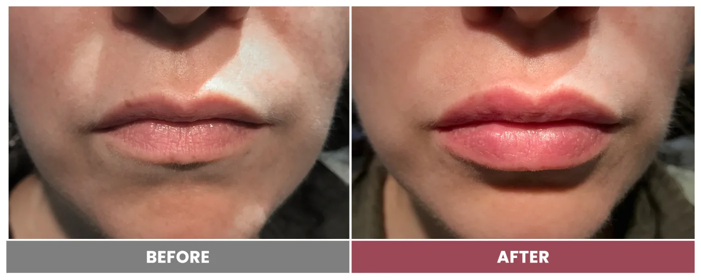NEUROMODULATORS & DERMAL FILLERS - Case 23