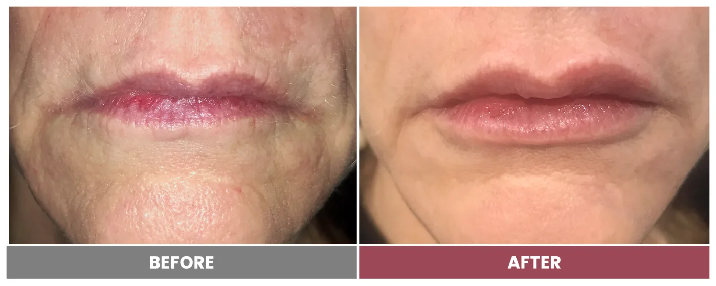NEUROMODULATORS & DERMAL FILLERS - Case 25