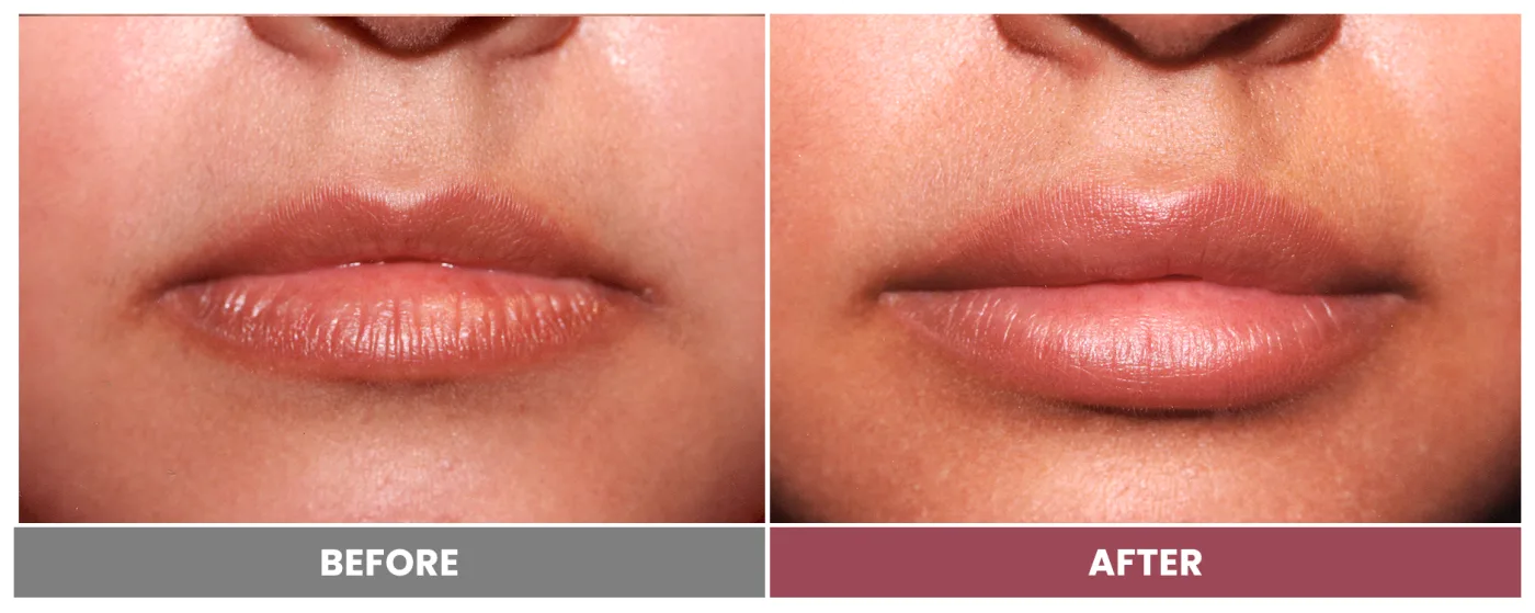 NEUROMODULATORS & DERMAL FILLERS - Case 26