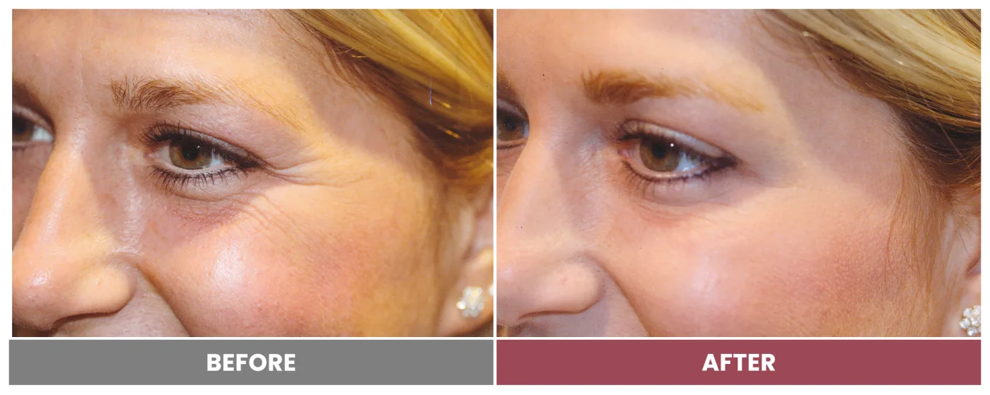 NEUROMODULATORS & DERMAL FILLERS - Case 4