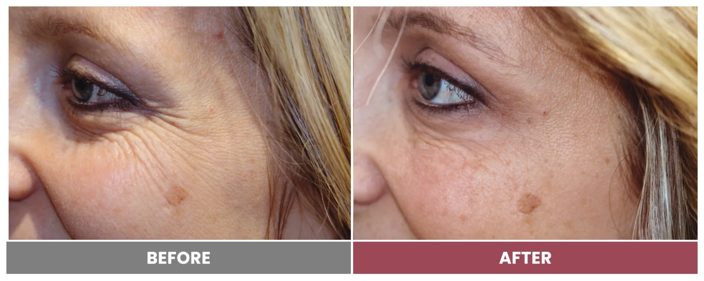 NEUROMODULATORS & DERMAL FILLERS - Case 5