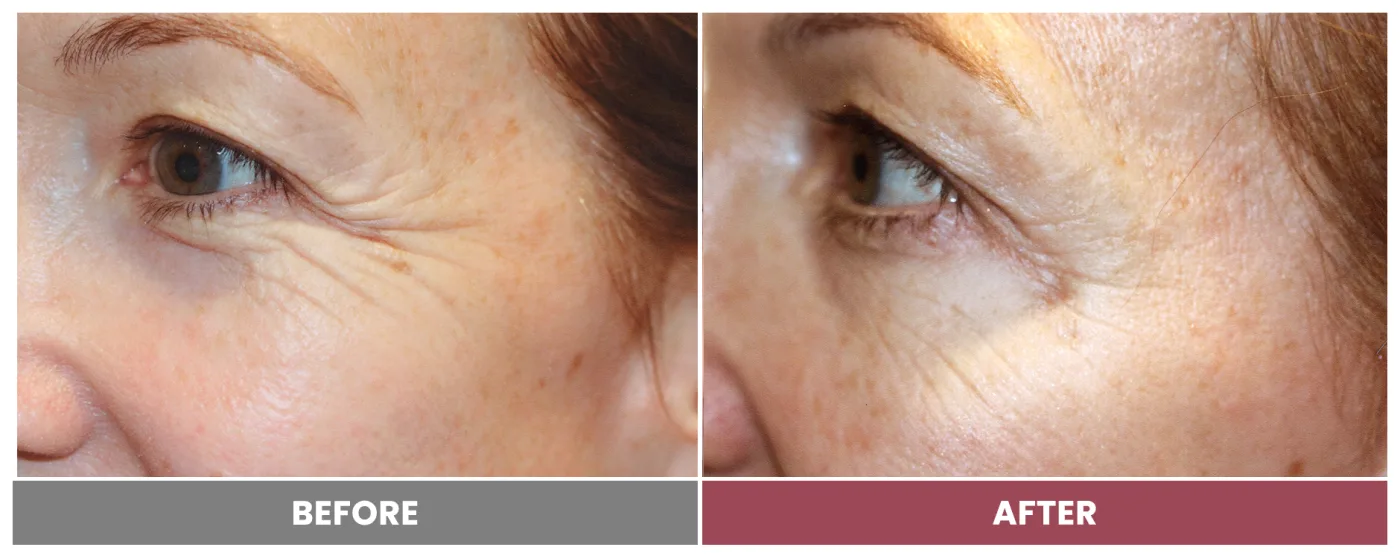 NEUROMODULATORS & DERMAL FILLERS - Case 6