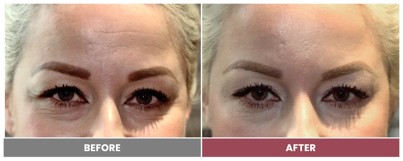 NEUROMODULATORS & DERMAL FILLERS - Case 8