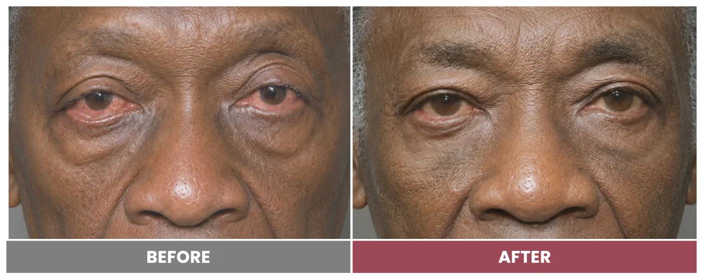 ECTROPION & ENTROPION REPAIR - Case 1