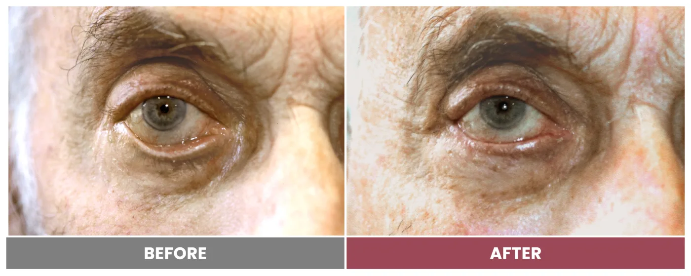 ECTROPION & ENTROPION REPAIR - Case 10