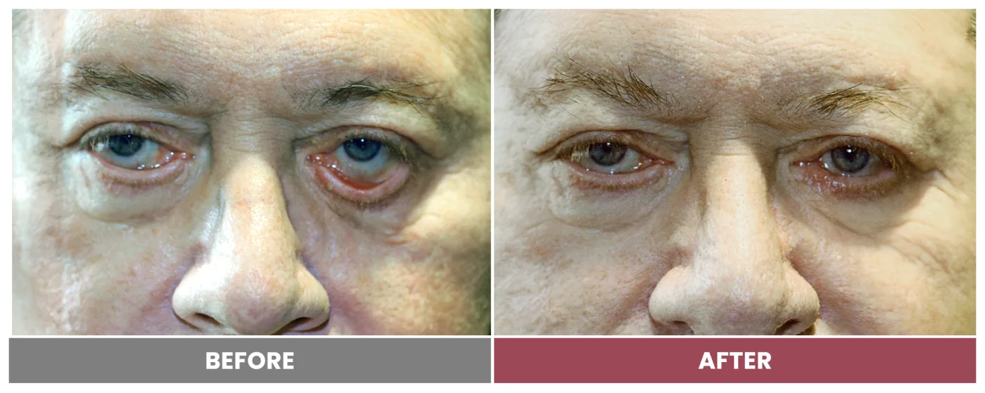 ECTROPION & ENTROPION REPAIR - Case 11