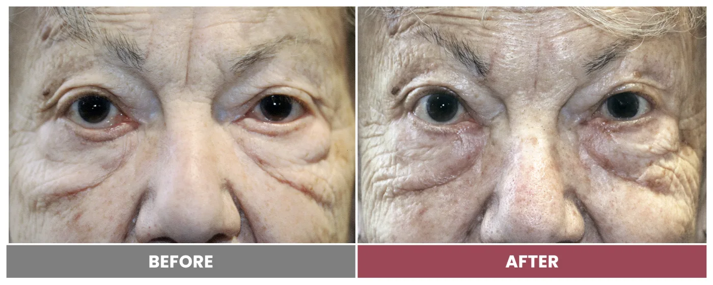 ECTROPION & ENTROPION REPAIR - Case 12