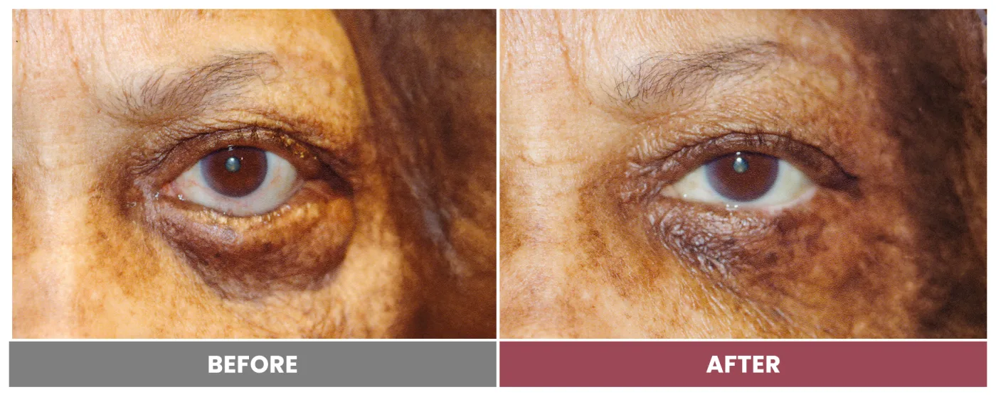 ECTROPION & ENTROPION REPAIR - Case 13