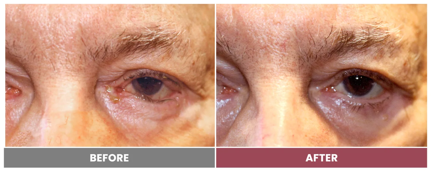 ECTROPION & ENTROPION REPAIR - Case 15