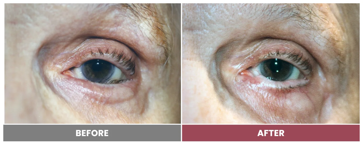 ECTROPION & ENTROPION REPAIR - Case 17