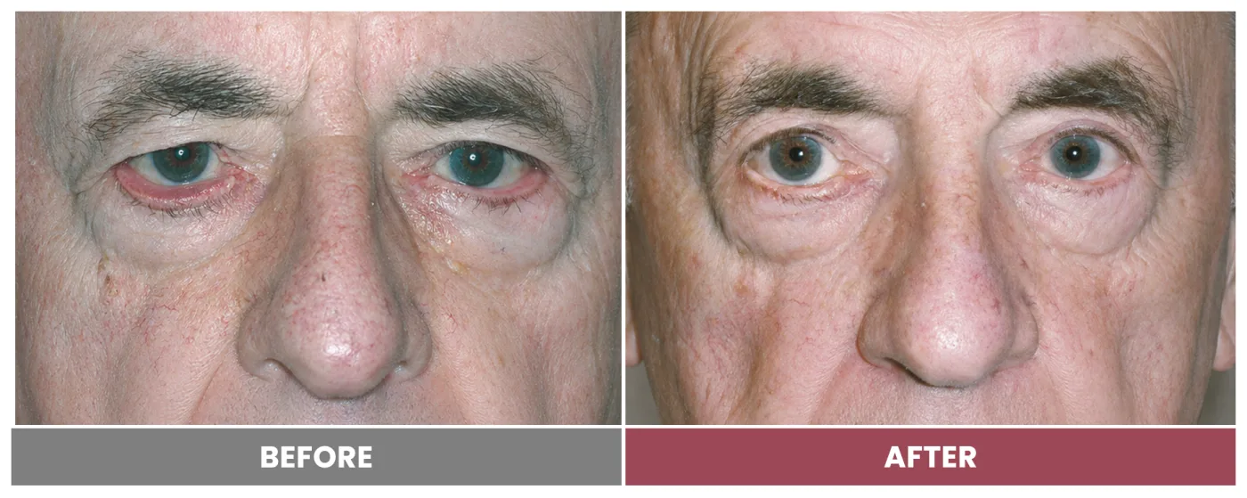 ECTROPION & ENTROPION REPAIR - Case 2