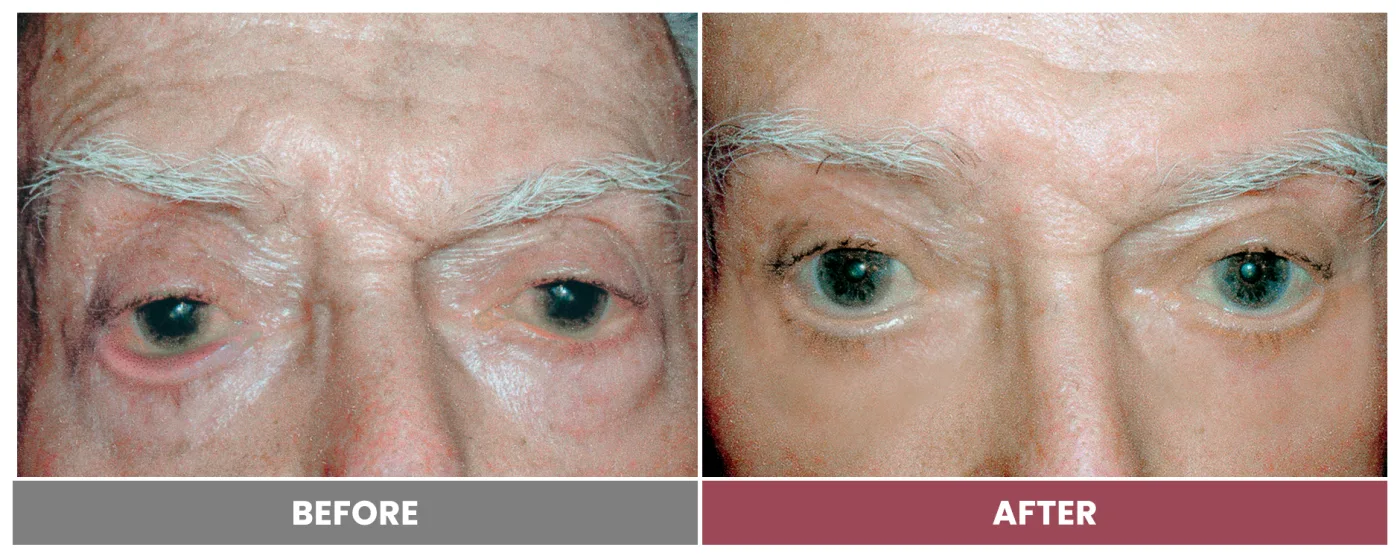 ECTROPION & ENTROPION REPAIR - Case 3