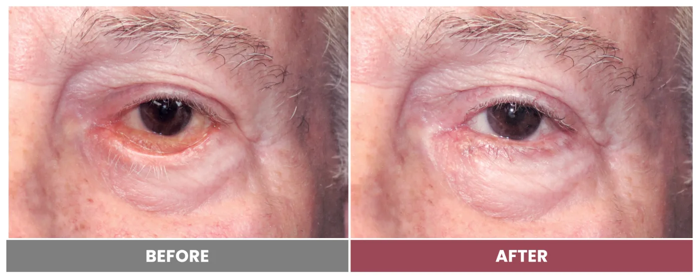 ECTROPION & ENTROPION REPAIR - Case 4