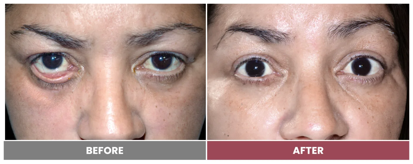 ECTROPION & ENTROPION REPAIR - Case 5