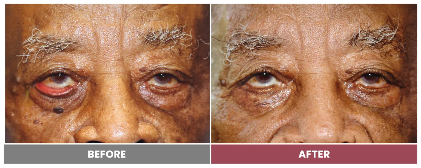 ECTROPION & ENTROPION REPAIR - Case 6