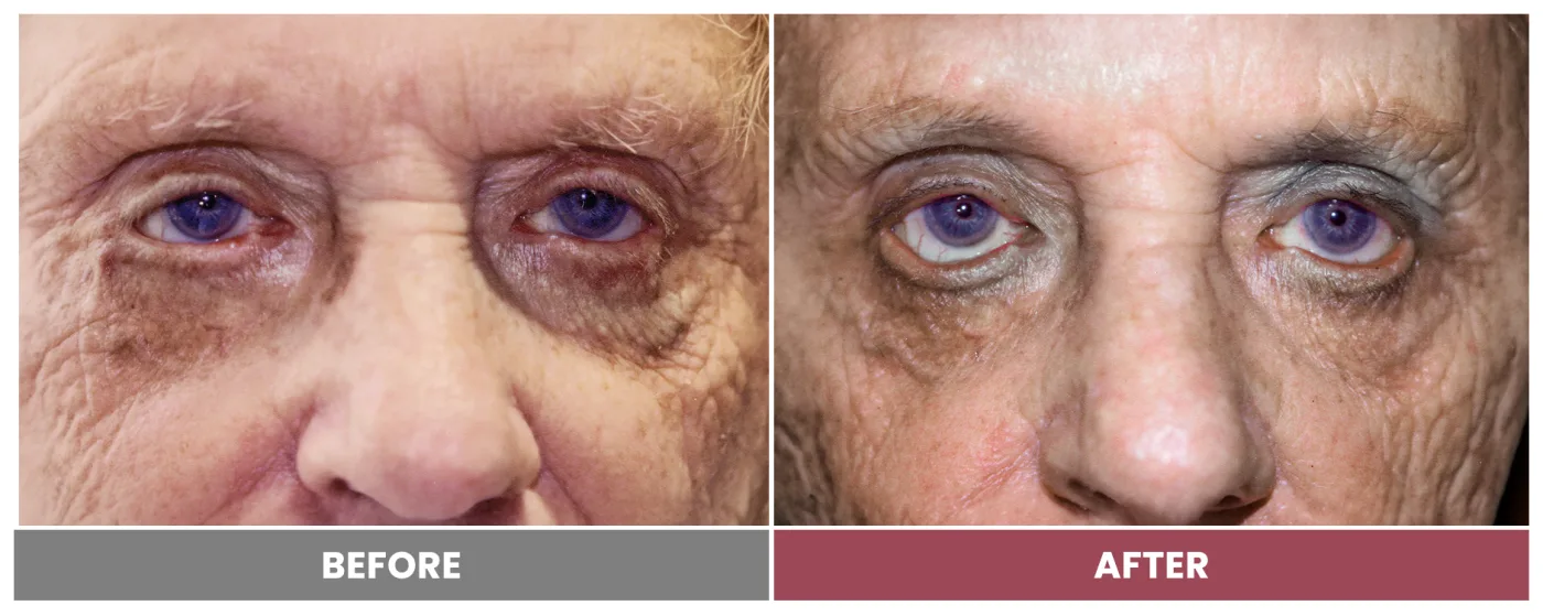 ECTROPION & ENTROPION REPAIR - Case 7
