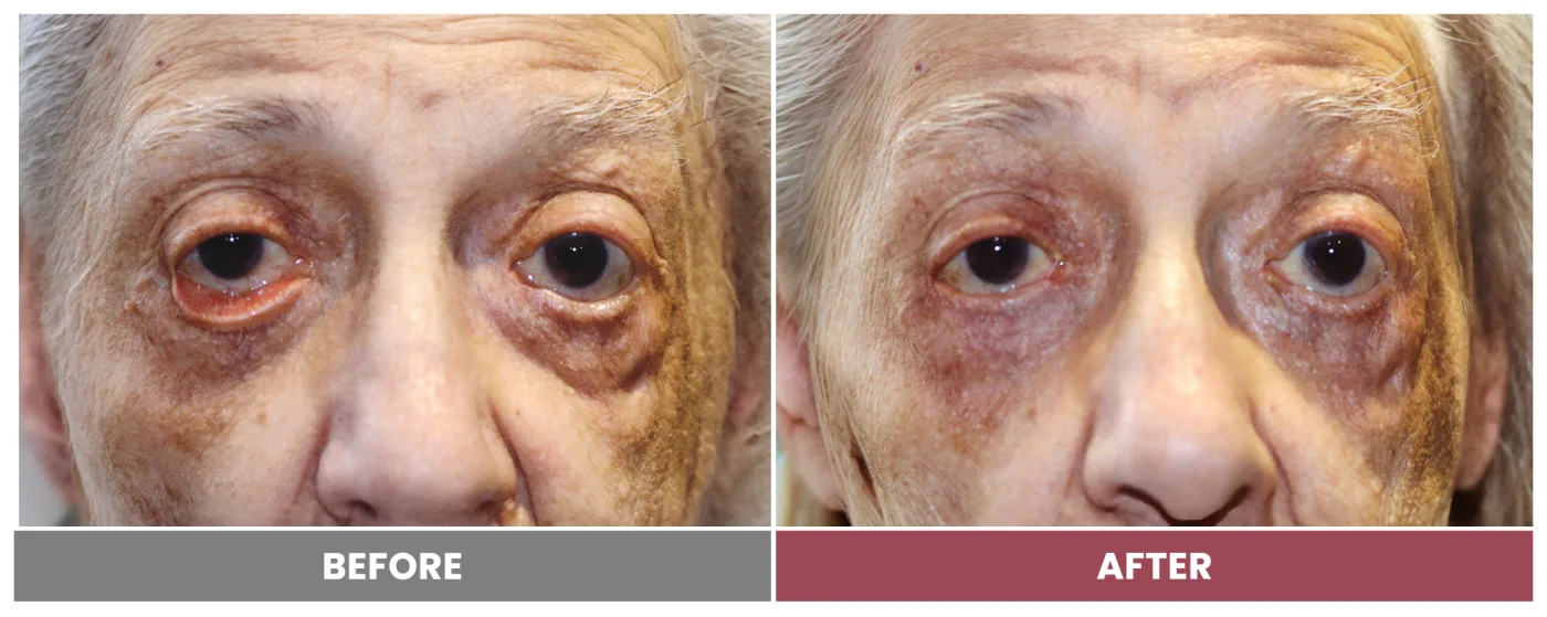 ECTROPION & ENTROPION REPAIR - Case 8