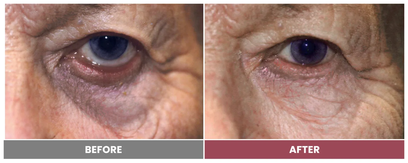 ECTROPION & ENTROPION REPAIR - Case 9