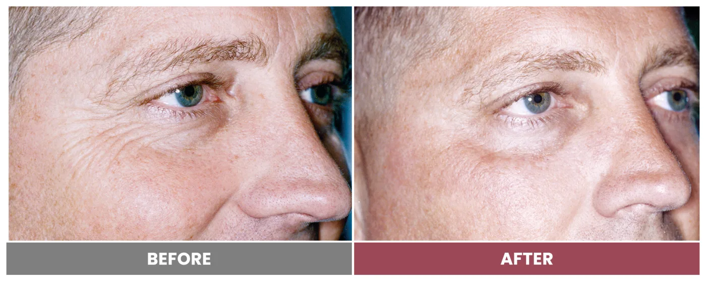 LASER SKIN RESURFACING - Case 1