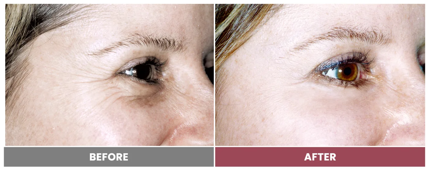 LASER SKIN RESURFACING - Case 2