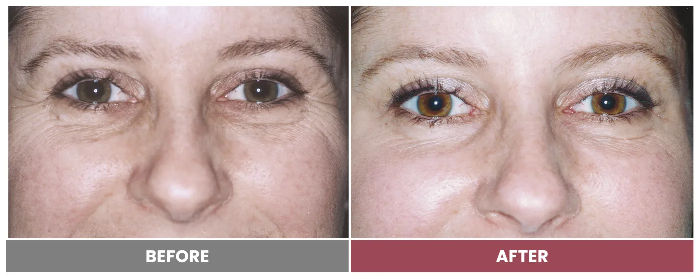 LASER SKIN RESURFACING - Case 3