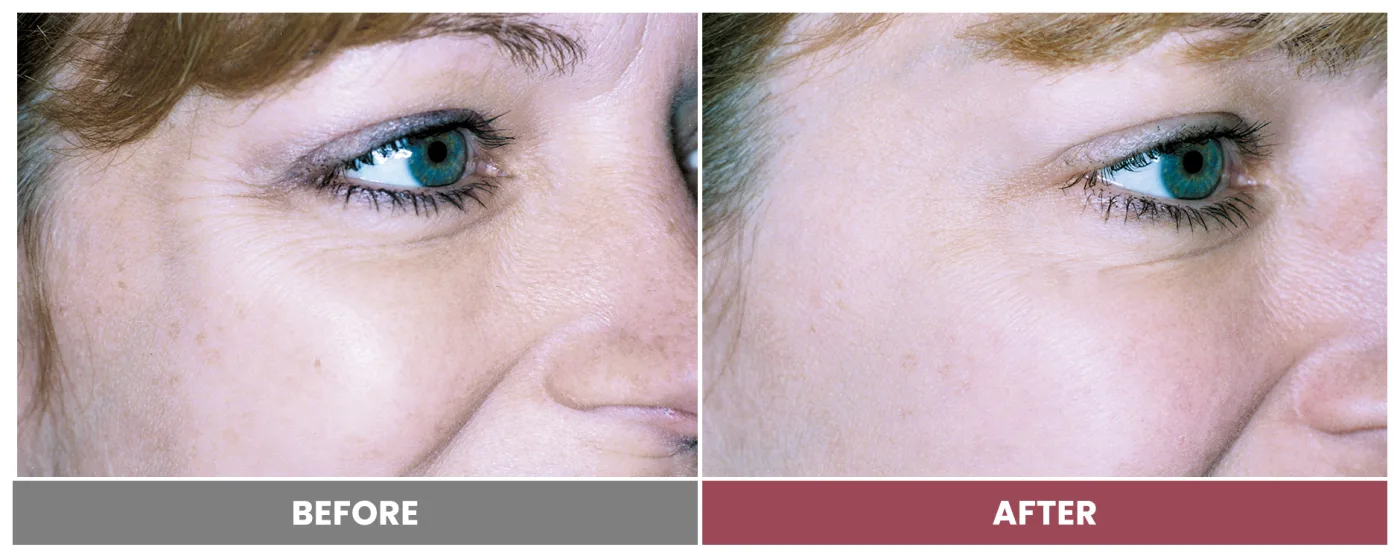 LASER SKIN RESURFACING - Case 5