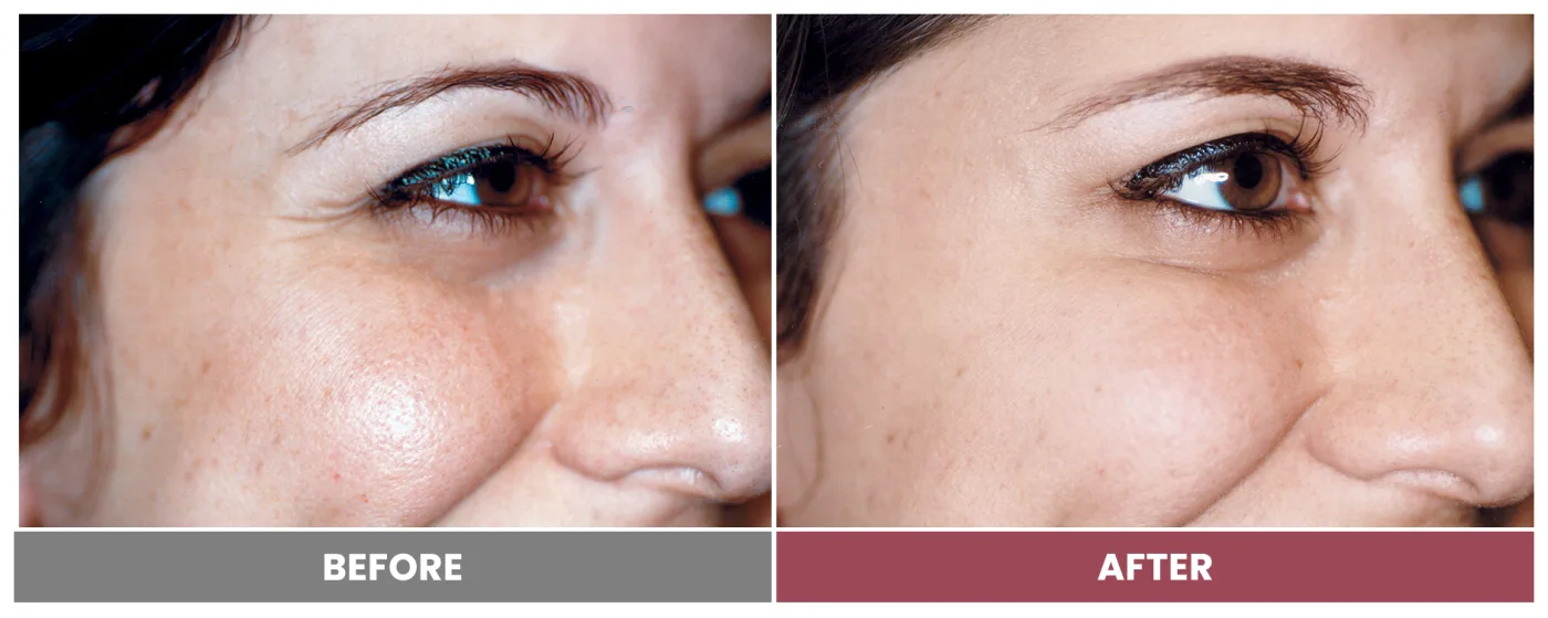 LASER SKIN RESURFACING - Case 7