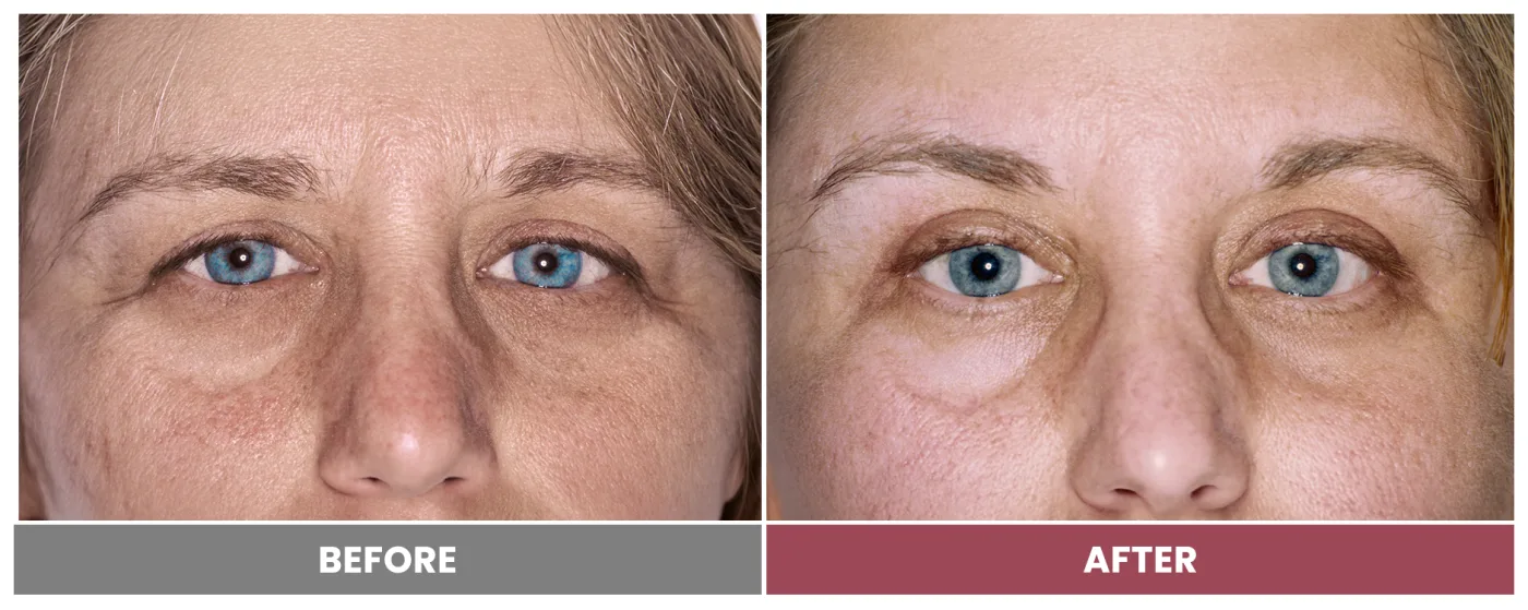 LASER SKIN RESURFACING - Case 8