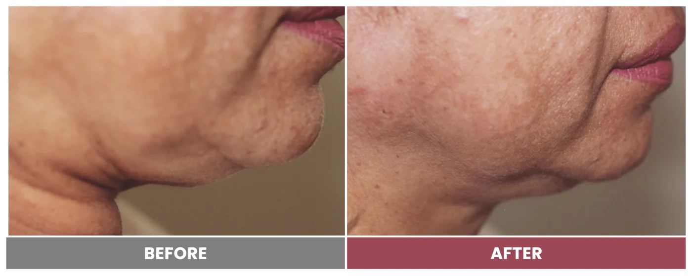 PDO THREAD LIFT FOR SKIN TIGHTENING - Case 2